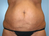 Tummy Tuck