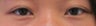 Asian Eyelid Surgery