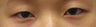 Asian Eyelid Surgery