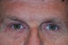 Endoscopic Brow Lift