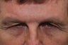 Endoscopic Brow Lift