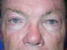left eyebrow lift after facial nerve paralysis