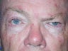 left eyebrow lift after facial nerve paralysis