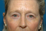 Lower lid bags removed via blepharoplasty