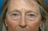 Lower lid bags removed via blepharoplasty