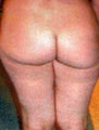 liposuccion before and after