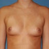 Breast Implants Augmentation Enlargement Enhancement