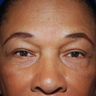 Brow Lift