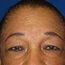Brow Lift