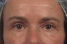 Upper eyelid and festoon treatment