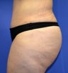 38 year old that had a Tummy Tuck, liposuction of her waist, Brazillian Butt Lift