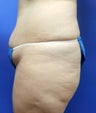 38 year old that had a Tummy Tuck, liposuction of her waist, Brazillian Butt Lift