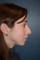 Nose Surgery