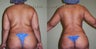 Brazilian Butt Lift