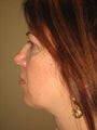 Smart Lipo