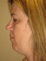 Smart Lipo