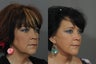 Facelift
