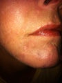 Acne scarring and Melasma