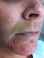 Acne scarring and Melasma