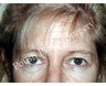 Forehead Lift