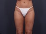 Liposuction Inner & Outer Thighs