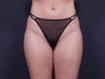 Liposuction Inner & Outer Thighs