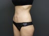 Mini tummy tuck / abdominoplasty with liposuction