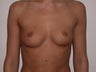 Breast Augmentation