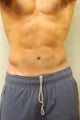SmartLipo