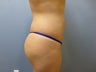 Brazilian Butt Lift