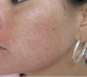Acne scarring treated with filler