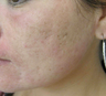 Acne scarring treated with filler