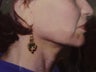 neck lift before after