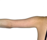 Laser Liposuction