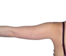 Laser Liposuction