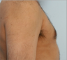 Male Breast Reduction