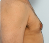 Male Breast Reduction