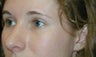 Rhinoplasty