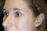 Rhinoplasty