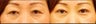 Asian Eyelid Surgery for Excess Skin