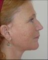 Neck Lift