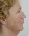 Neck Lift