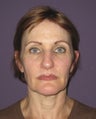 Facelift