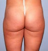 Liposuction for Mother of Two