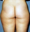 Liposuction for Mother of Two