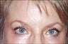 Removing wrinkles from brow area