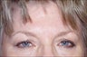 Removing wrinkles from brow area