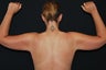 Brachioplasty