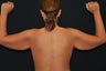 Brachioplasty