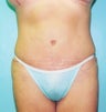 Tummy Tuck